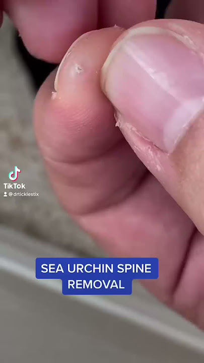 SEA URCHIN SPINE IN MY FINGER: REMOVAL #shorts #shortsvideo #fyp