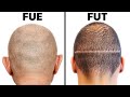 FUE vs. FUT Hair Transplant Harvesting