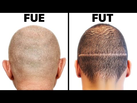 FUE vs. FUT