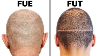 FUE vs. FUT Hair Transplant Harvesting