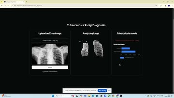 Custom-Trained AI for Tuberculosis Diagnosis via Chest X-Ray