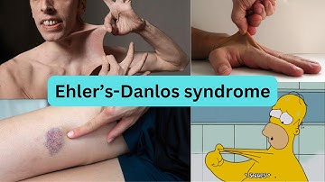 Ehlers-Danlos Syndrome Explained: The Mnemonic You’ll Never Forget!