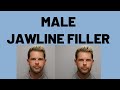 Male Jawline Filler Procedure with Dr. Rosenberg