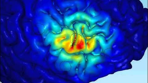 High-Definition tDCS with 4x1 montage
