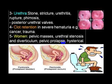 ACUTE RETENTION OF URINE