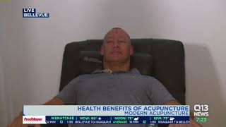 Health benefits of acupuncture