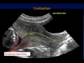 Sonography of the cervix