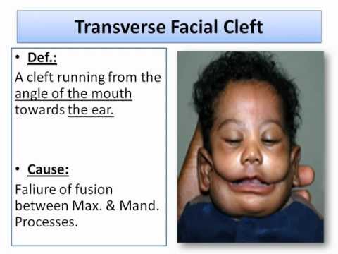 Developmental Disturbances of The Soft Tissues (part1).(Oral Pathology).wmv