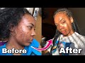 HOW I CLEARED MY ACNE SUPER FAST! || My Skin Journey ✨