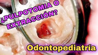 PULPOTOMÍ4 Y EXTR4CCIÓN INF4NTIL 🚨EN VIVO🚨(Odontopediatría LIVE) by ESPECIALIDADES ODONTOLOGICAS 3,562 views 3 years ago 14 minutes, 52 seconds