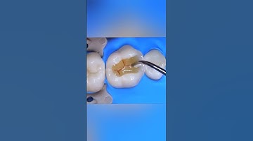 Dental motivation. Direct composite restoration teeth. Modeling anatomy teeth. #dental #dentistry