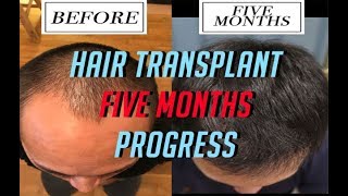 5 MONTHS Hair Transplant Update! FUE Surgery Post Progress Results