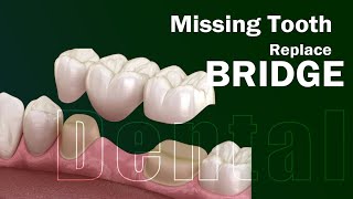 Temporary Dental Bridge || Dr.Sanjeeb Rout