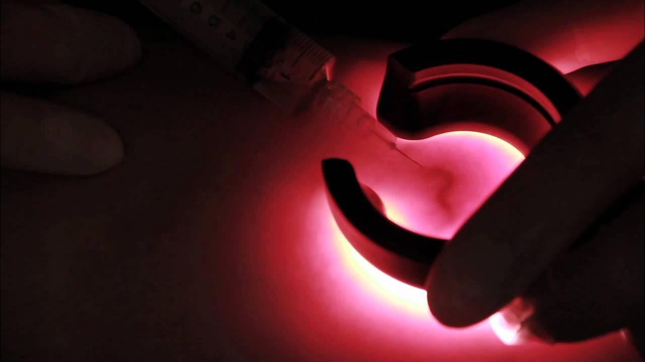 Ледыкс тарков. Трансиллюминатор veinlite. Светодиодный трансиллюминатор кожи ledx. Светодиодный трансиллюминатор кожи. Трансиллюминатор для вен.