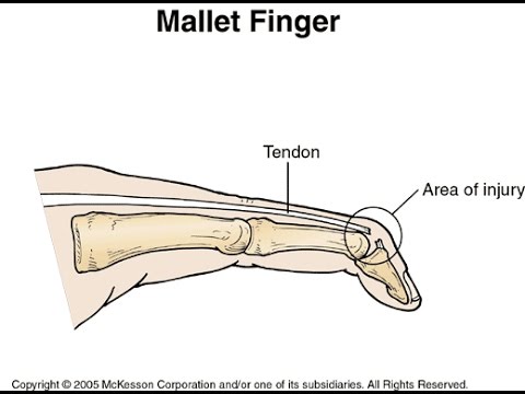 Que es el Mallet Finger / Rehabilitación
