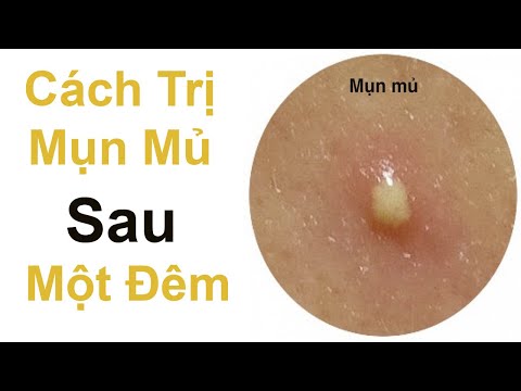 Cách Trị Mụn Mủ Sau Một Đêm Hiệu Quả Ngoài Mong Đợi - Mỹ Phẩm SOSENCO