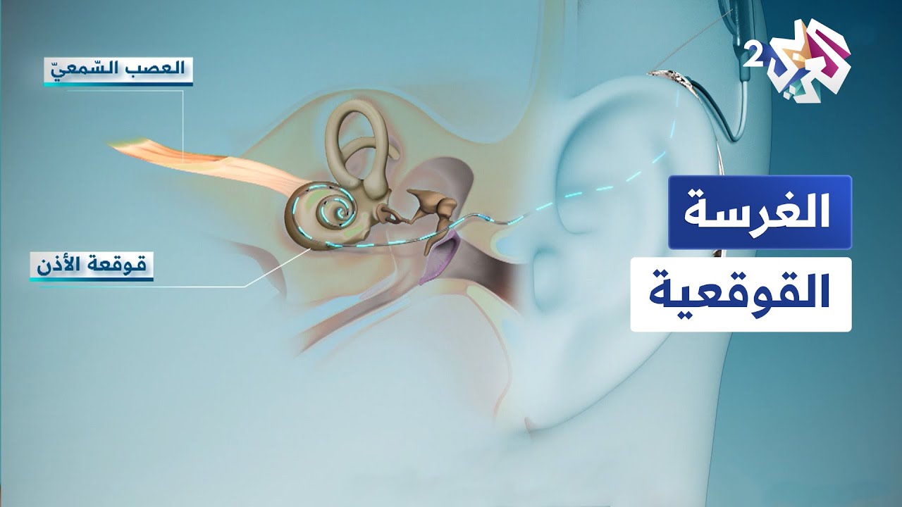 الغرسة القوقعية لتحسين سمع الأشخاص المصابين بفقدان السمع الحاد