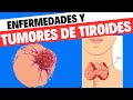 Tumores y enfermedades de tiroides. Todo lo que necesitas saber