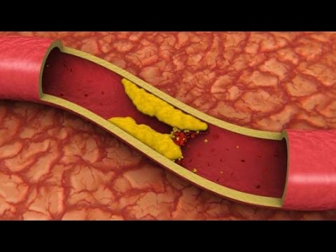 Video: Niyə ateroskleroz infarktla nəticələnir?