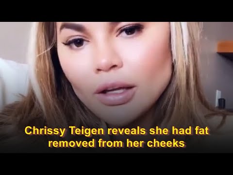 Chrissy Teigen reveals she had fat removed from her cheeks