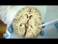 Базальные ядра головного мозга