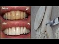 تبييض الأسنان والتخلص من الإصفرار ضعيها لأسنانك دقيقة واحدة فقط والنتيجة مبهرة (قسما بالله مجربة )