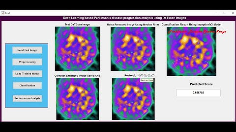 Deep Learning Based Parkinson