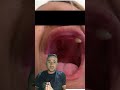 Você a displasia ectodérmica anidrótica?
