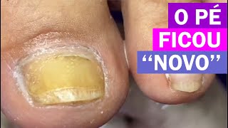 Alta de hipercurvatura. [Renata Werneck Podóloga - Unha Encravada] REMOVE INGROWN NAIL