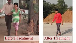 SSPE Treatment with Dr. Oswal's G Therapy #sspe #sspetreatment #subacutesclerosingpanencephalitis