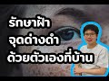 วิธีรักษา ฝ้า ด้วยตัวเองที่บ้านง่ายๆ | 10นาทีกับหมอต่อ