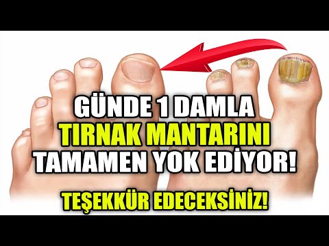 Günde 1 Damla Yetiyor! Tırnak Mantarını Tamamen Yok Ediyor!