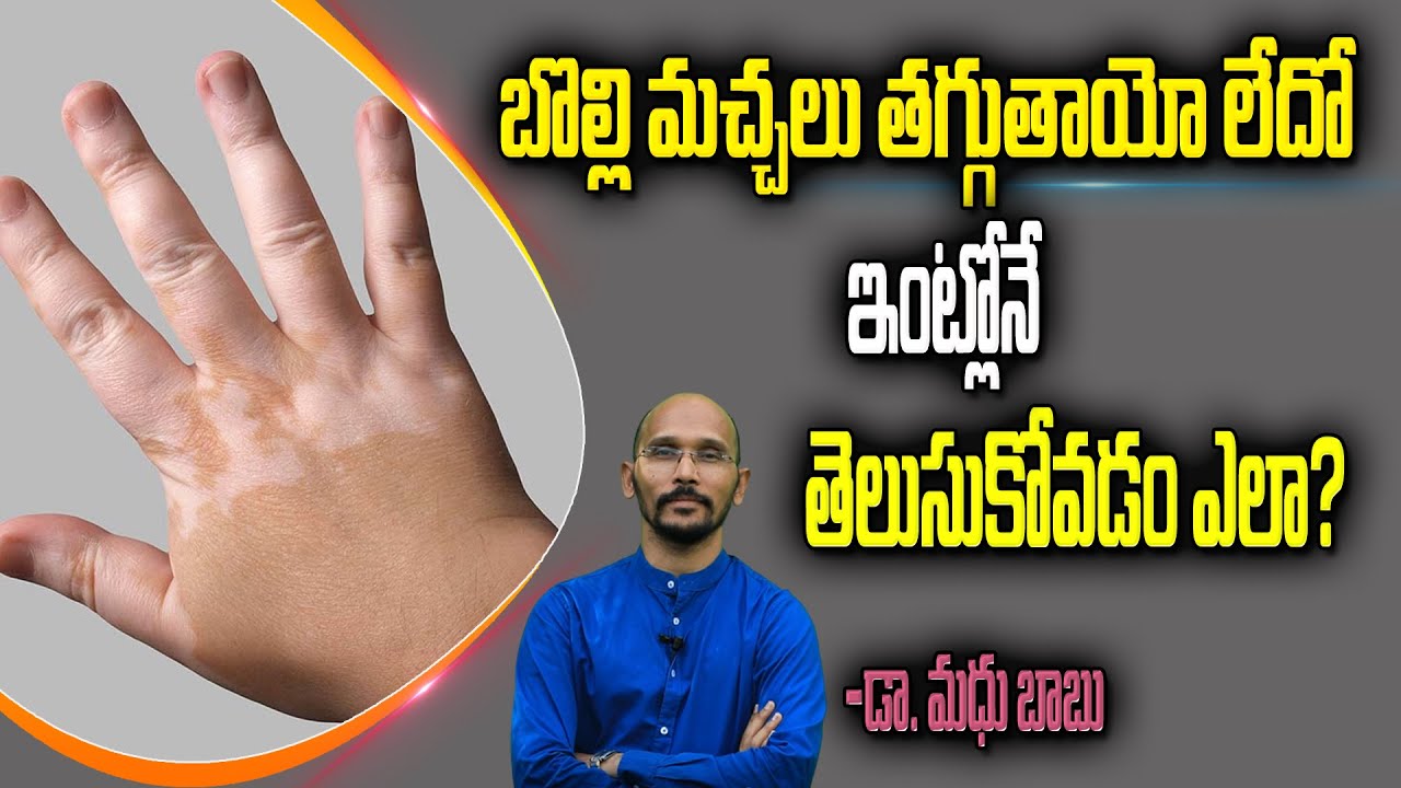 How to know whether Vitiligo spots will reduce or not?Clear Explanation @Dr.Madhu Babu Health Trends