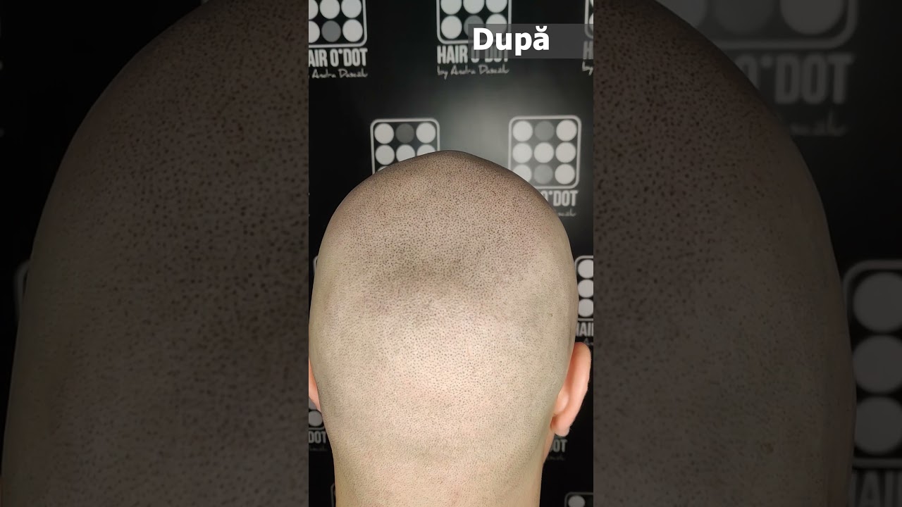 Adio Chelie Micropigmentare Scalp