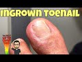 Extraction of an Extremely Painful Ingrown Toenail