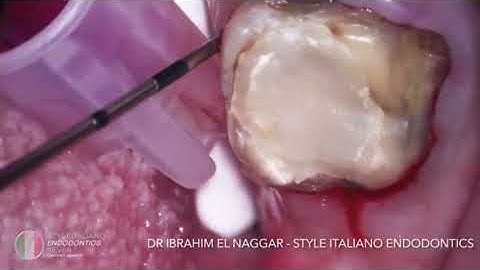 Detect and diagnose a perforation by Dr. El Naggar | Endodontics | Deppeler Swiss Dental Instruments