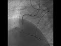 Pci for cto part 3 retrograde