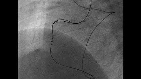 PCI for CTO part -3 retrograde