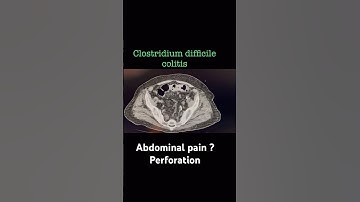 Clostridium difficile colitis , any perforation ? #CT #abdomen #radiology