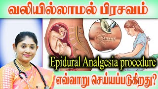 வலியில்லாமல் பிரசவம் எவ்வாறு செய்யப்படுகிறது ? What is epidural analgesia during labor?