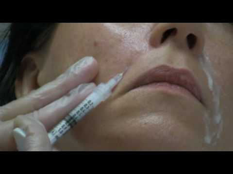 Video: Juvederm Vs. Restylane: Ihon Täyteaineiden Vertailu