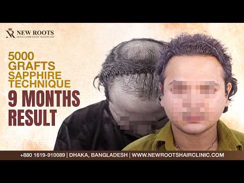 Sapphire Technique + 5000 Grafts… This Is His Hair Now! 😲 | Hair Transplant in Bangladesh