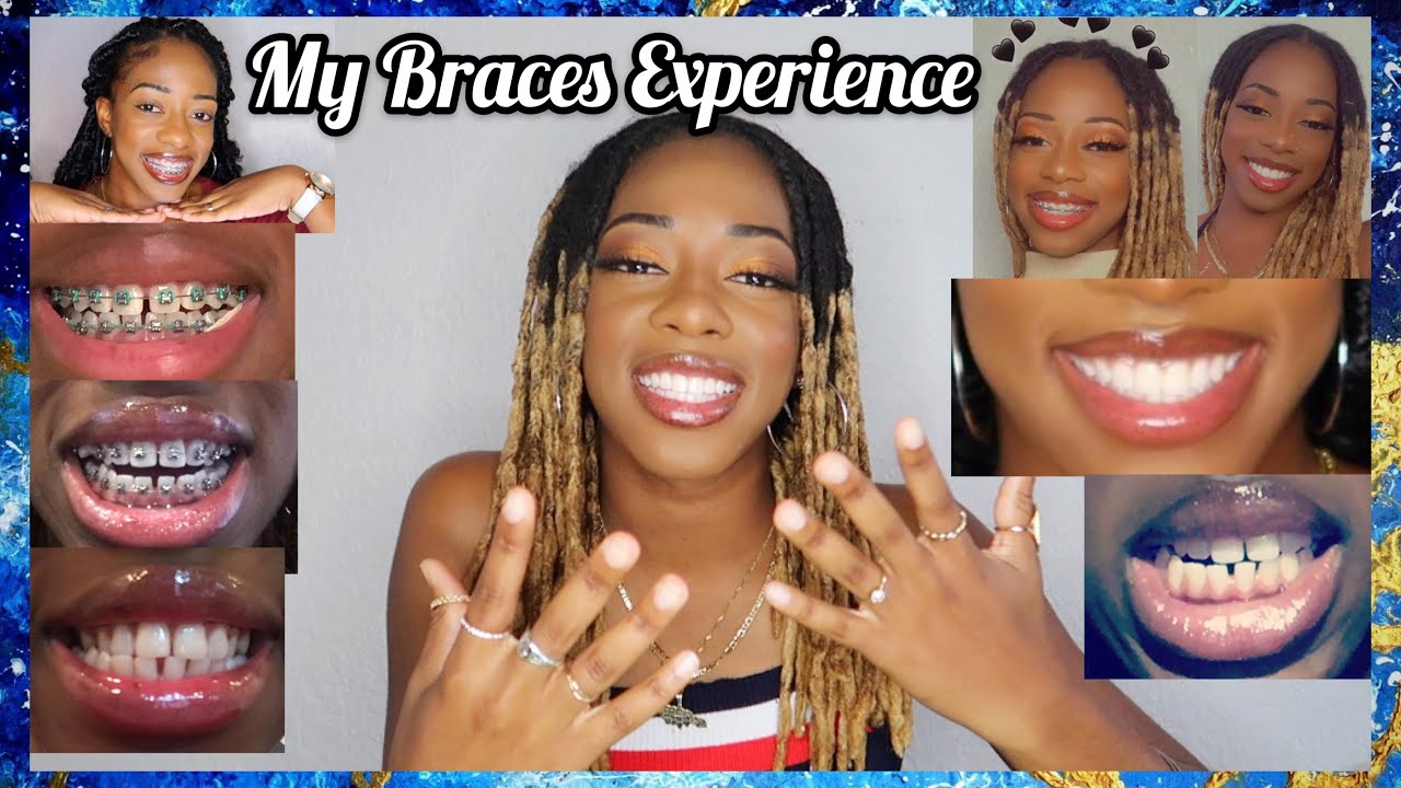 my braces journey