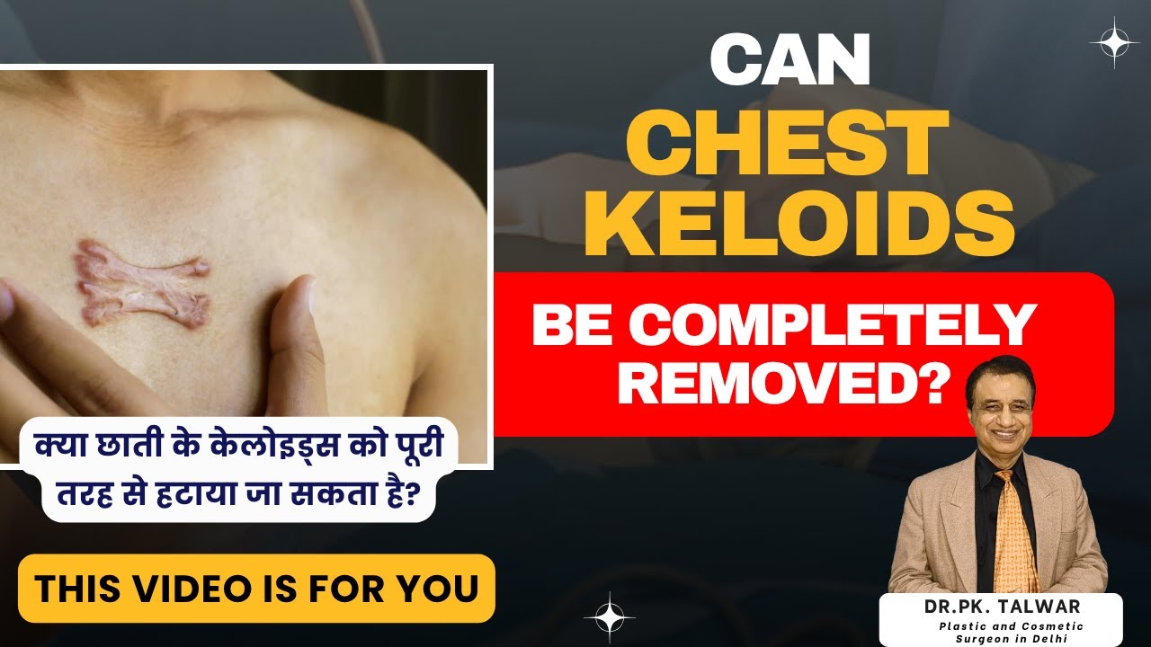 Can Chest Keloids Be Completely Removed? Final Truth by Dr. P.K. Talwar | Keloid Treatment Facts.