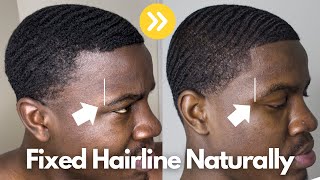 How I FIXED My Hairline Naturally | *Receding Hairline*