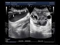 Ultrasound Video showing an ectopic pregnancy with dead fetus.