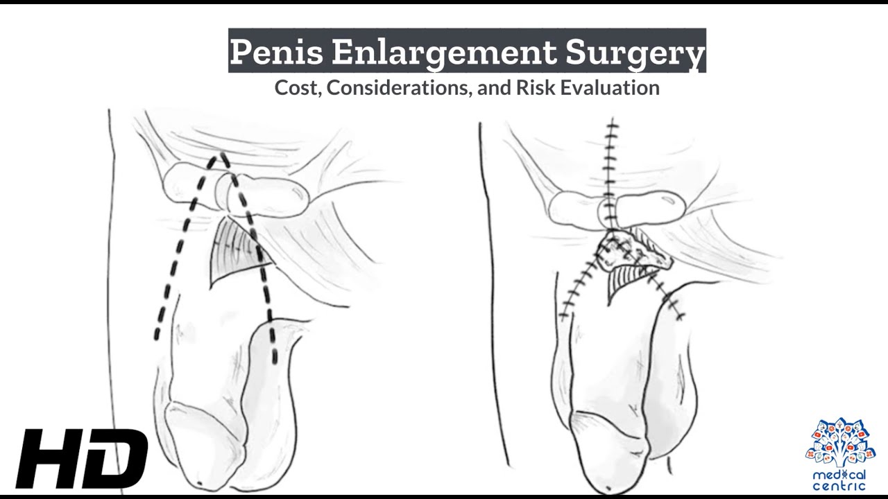 Is Penis Enlargement Surgery Worth the Risk? Pros and Cons 