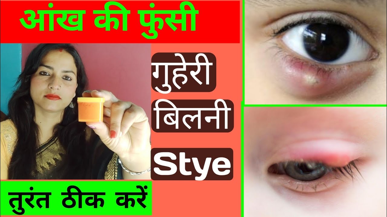GUHERI KAISE THIK KARE आंख की गुहेरी, बिलनी कैसे ठीक करें Eye Stye