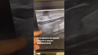 Нетипичная форма варикоза. Как лечить варикоз? Лечение вен. Флеболог Москва. Флеболог. Сосудистый