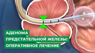 Аденома предстательной железы: оперативное лечение